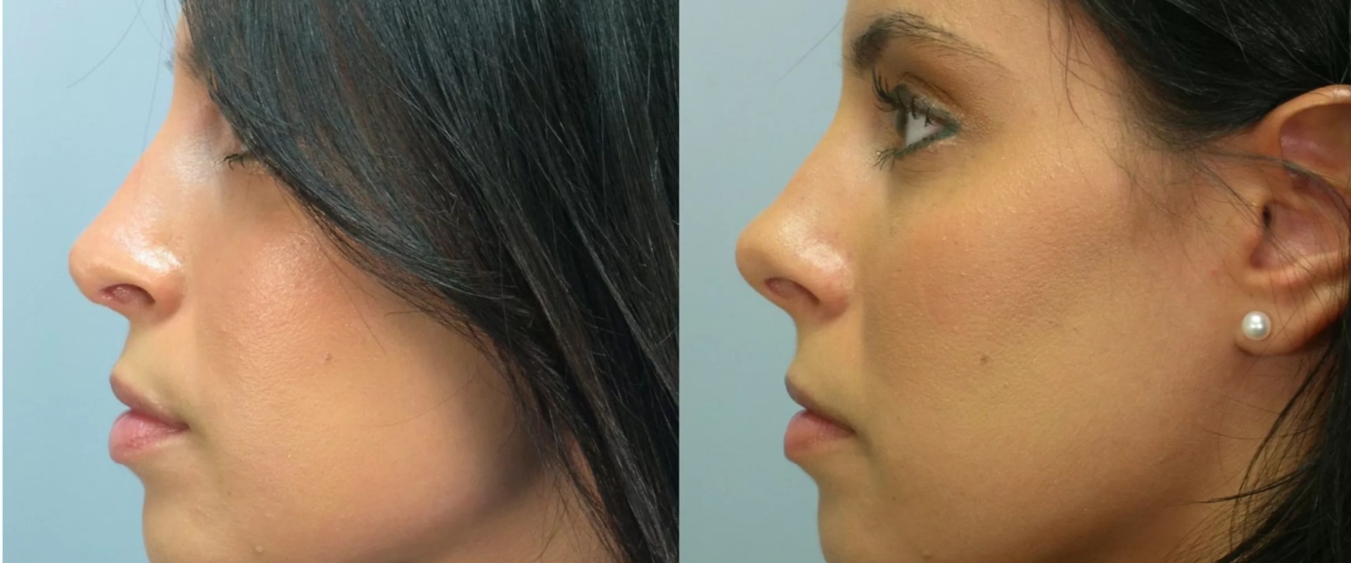 The Cost of a Nose Job: How to Afford the Procedure