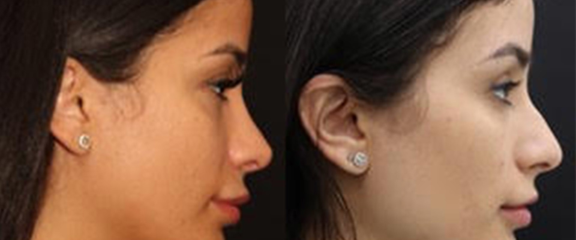 Where is the most affordable place to get a rhinoplasty?