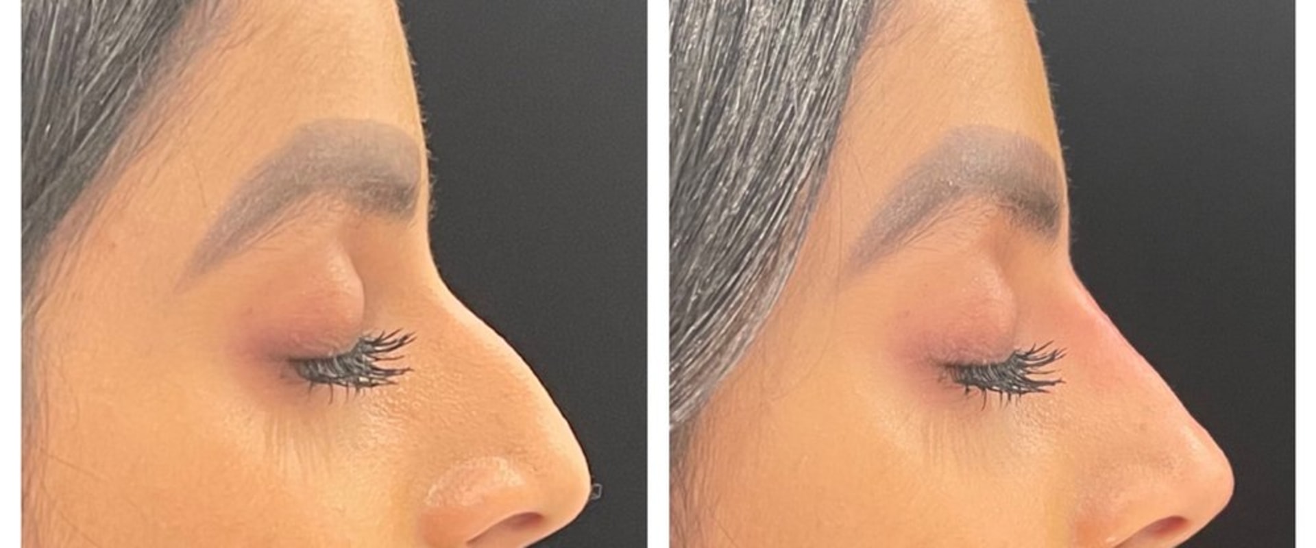 Real Results From The Top Rhinoplasty In Beverly Hills CA