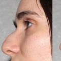 The Evolution of Minimally Invasive Rhinoplasty