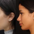 Where is the most affordable place to get a rhinoplasty?