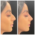 Real Results From The Top Rhinoplasty In Beverly Hills CA