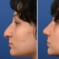 The Secret to Long-Lasting Rhinoplasty Results