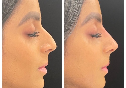 Real Results From The Top Rhinoplasty In Beverly Hills CA