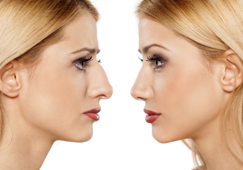 The Longevity of Non-Surgical Nose Reshaping