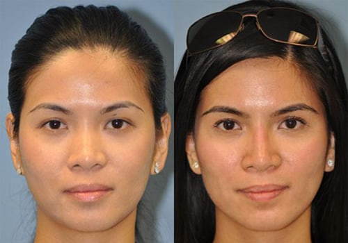 The Truth About Permanent Nose Reshaping: An Expert's Perspective